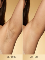 Lyviora® Smooth led hair removal